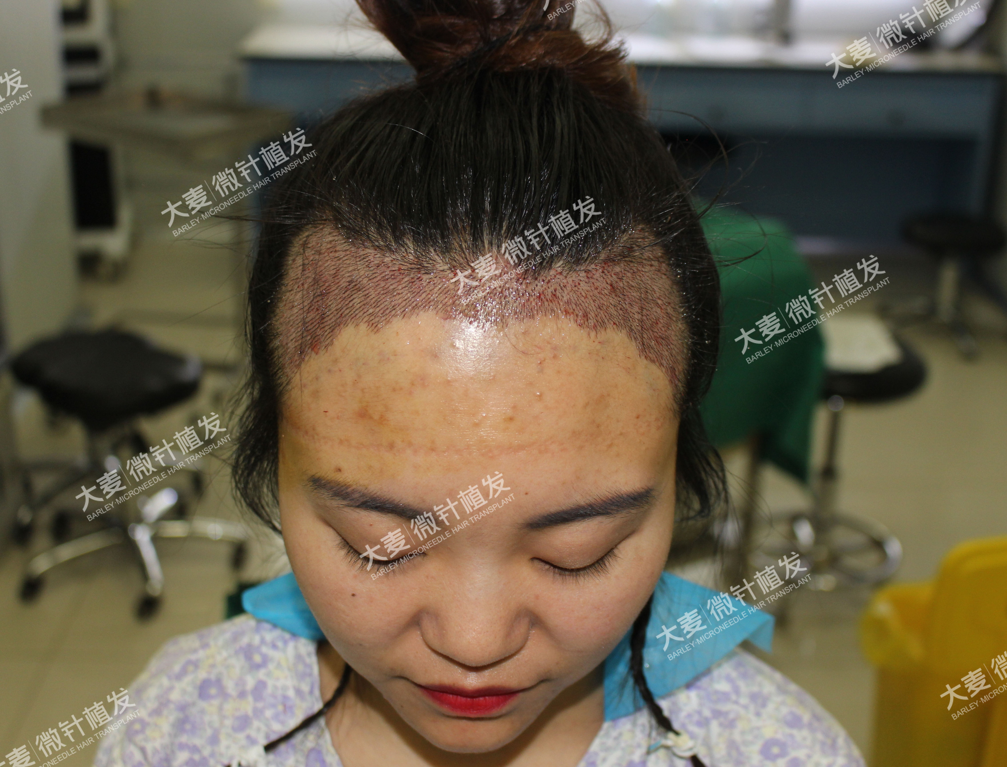 回际线空姐泰国spa_发际线调整要多少钱_长乐芦际潭森林公园要门票吗